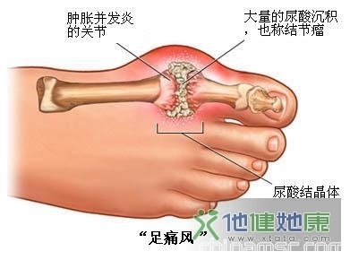 痛風(fēng)病患者用藥指南：持續(xù)用藥可防復(fù)發(fā)